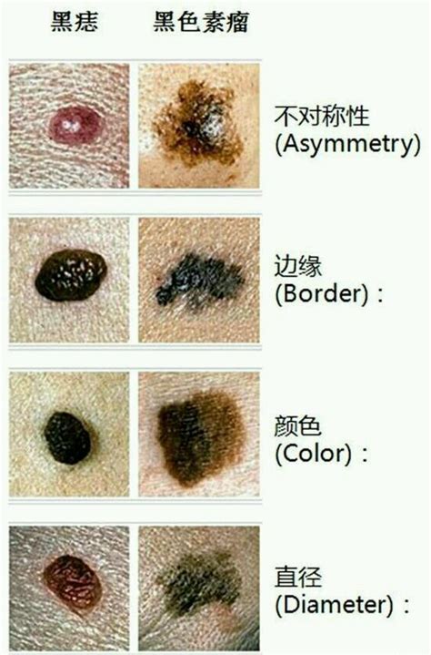 大黑痣|点痣不正规可能引发癌变：关于痣的 4 个常识